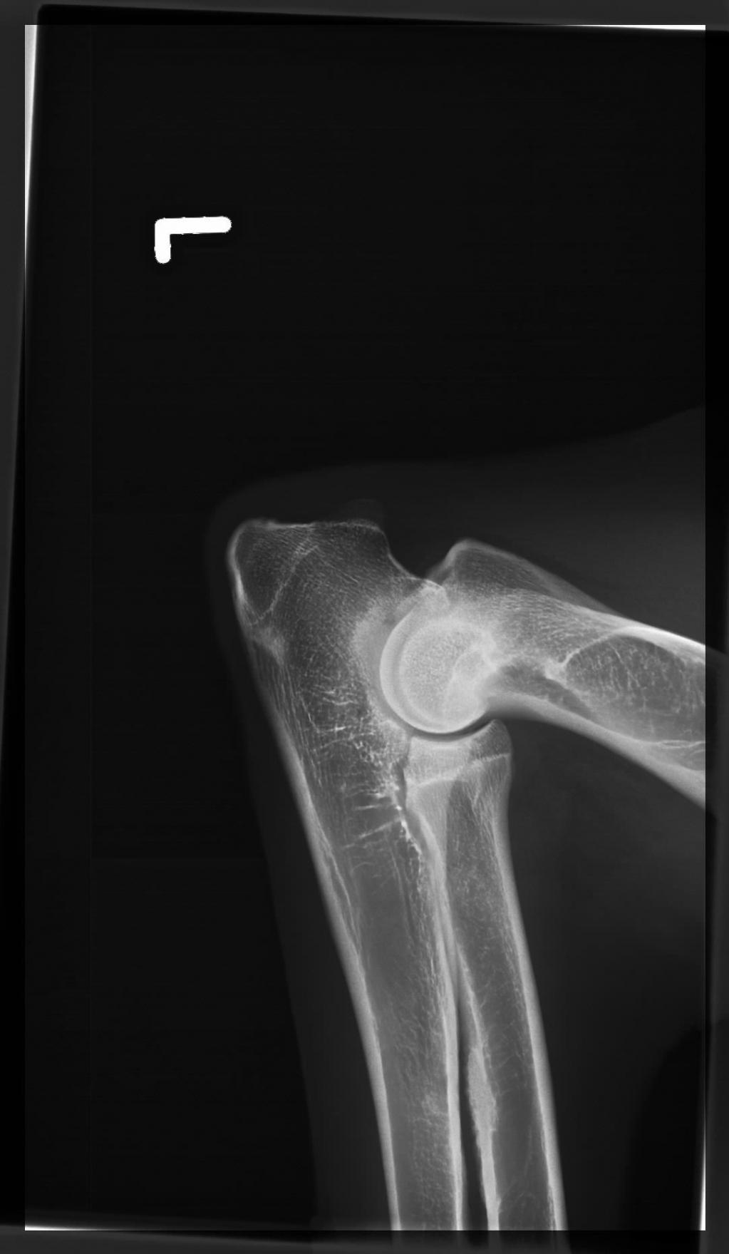 Digitale Röntgenaufnahme eines Ellbogens