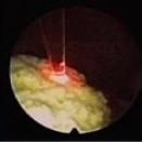 Laserlithotripsie (Harnsteinzertrümmerung)