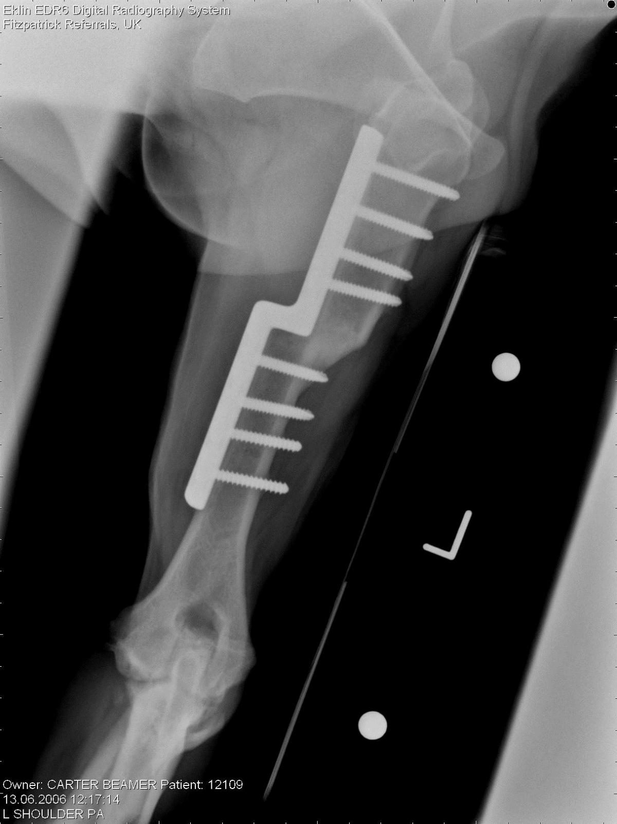 sliding humeral osteotomy (SHO)