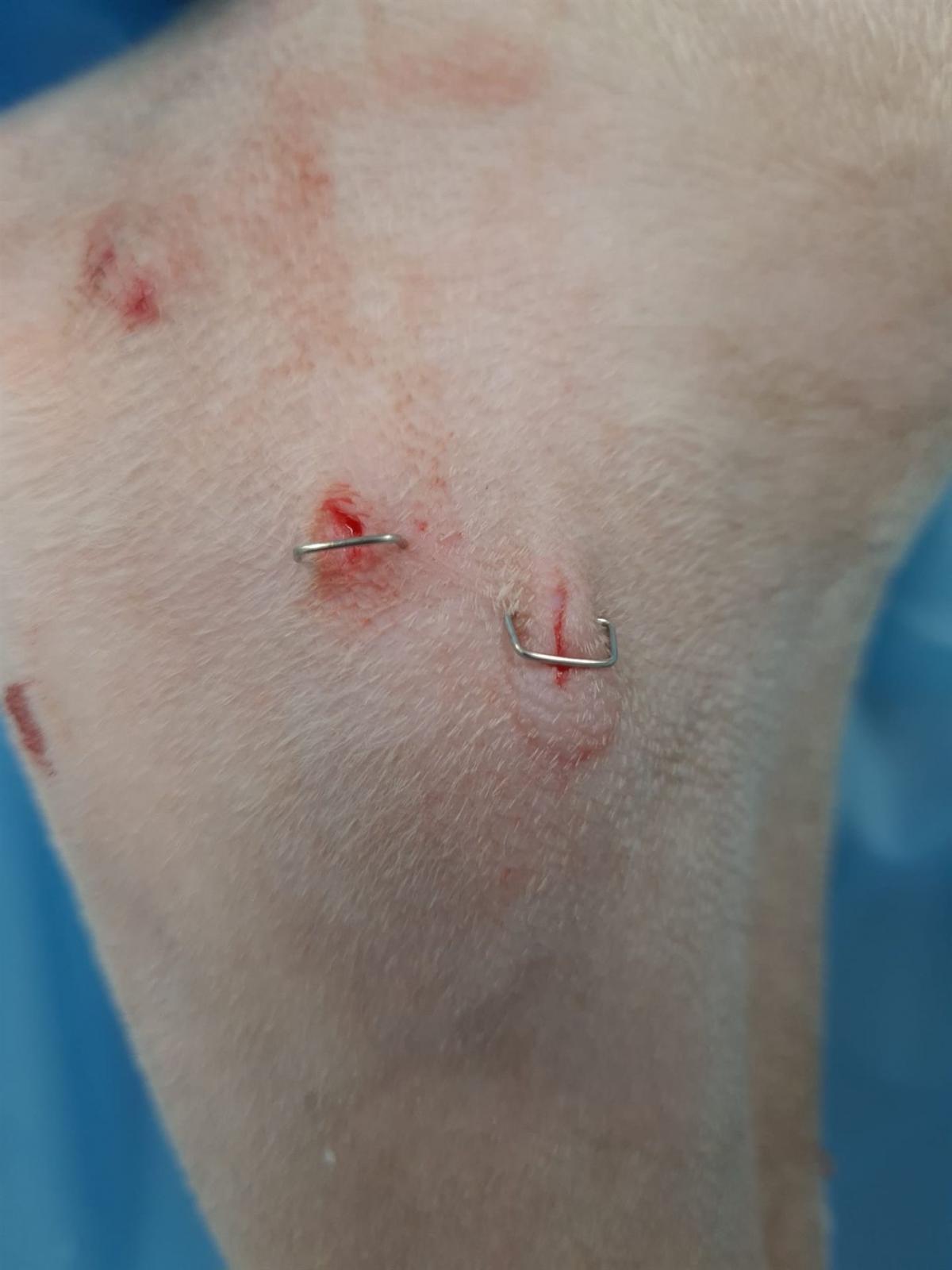 Ellenbogen post OP